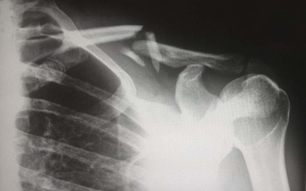 X-ray of a broken collarbone.